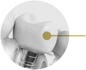 Tips To Choose The Right Dental Implant For Yourself