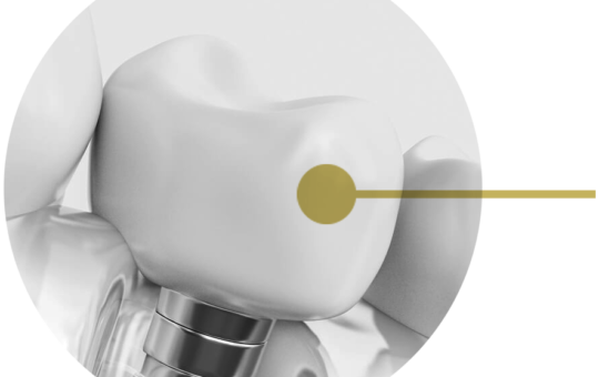 Tips To Choose The Right Dental Implant For Yourself