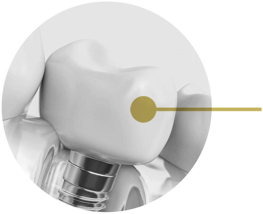 Tips To Choose The Right Dental Implant For Yourself